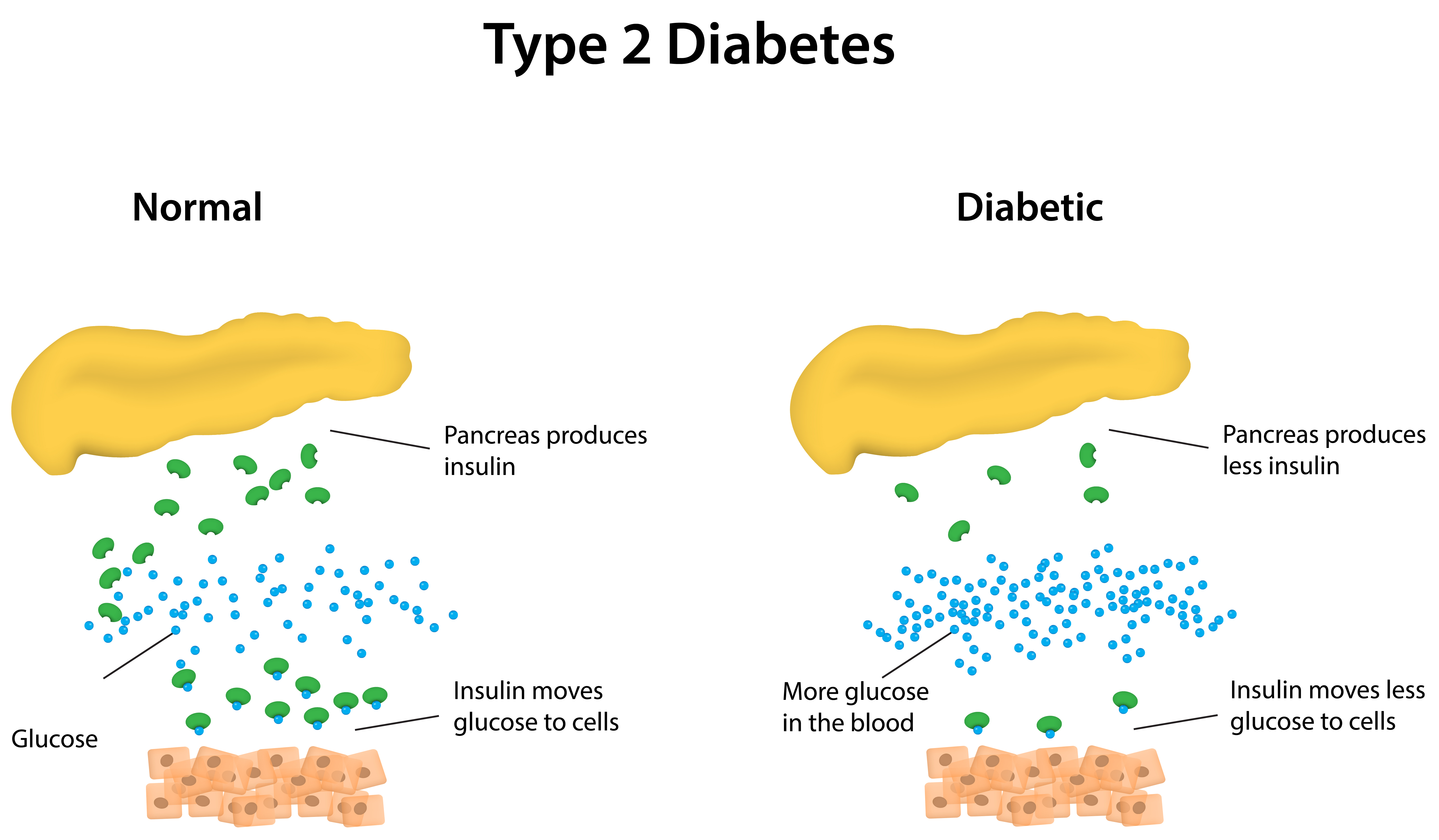 what is diabetes type 2)